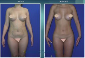 caso de mujer con lipoescultura