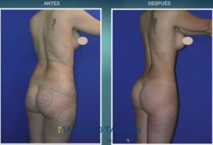 caso 1 de lipoescultura foto de perfil