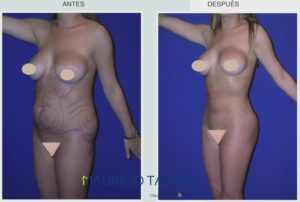 foto de perfil de caso 2 de lipoescultura