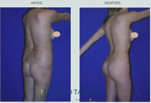 perfil derecho de paciente de lipoescultura