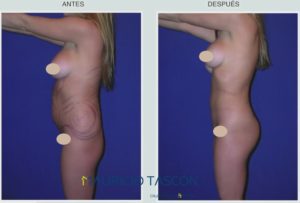 perfil izquierdo del antes y el despues de la lipoescultura