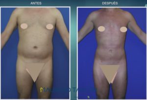 caso de hombre frontal