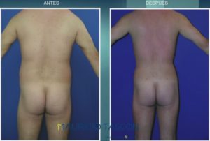 caso de lipoescultura en hombre de espaldas
